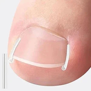 At Home Ingrown Toenail Corrector Strips Pedicure Kit